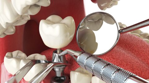 Which In Turn Country Should A person Choose To Obtain Dental Implants